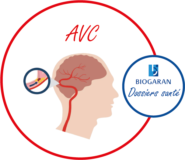 Comprendre L'AVC - Biogaran Proche Et Moyen Orient